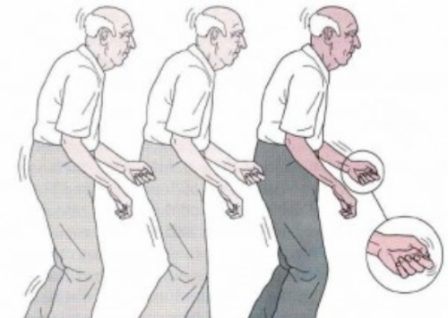 Doença de Parkinson: como identificar?